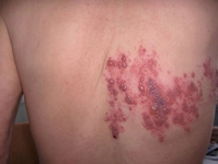 Penisilin Alerjisi Belirtileri ve Tedavisi