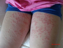 Küf Mantarı Alerjisi Belirtileri ve Tedavisi