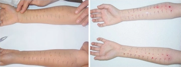 Çocuk Alerji Testi Nedir ve Nasıl Yapılır?