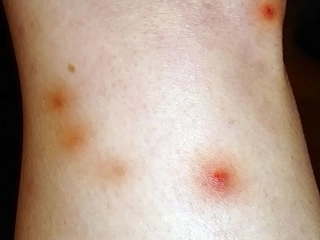 Pire Alerjisi Belirtileri ve Tedavisi