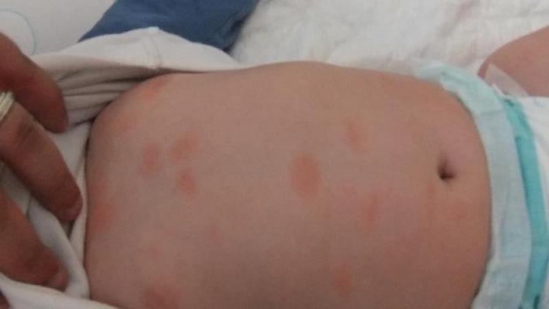 Bebeklerde Ceviz Alerjisi Belirtileri Ve Tedavisi